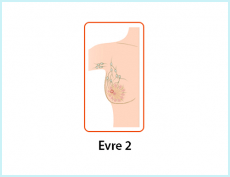 meme-kanseri-evre-2
