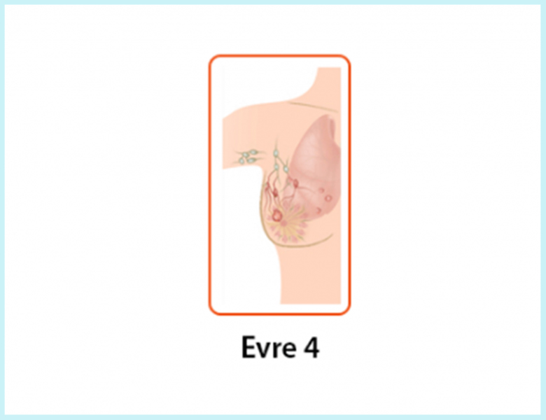 meme-kanseri-evre-4